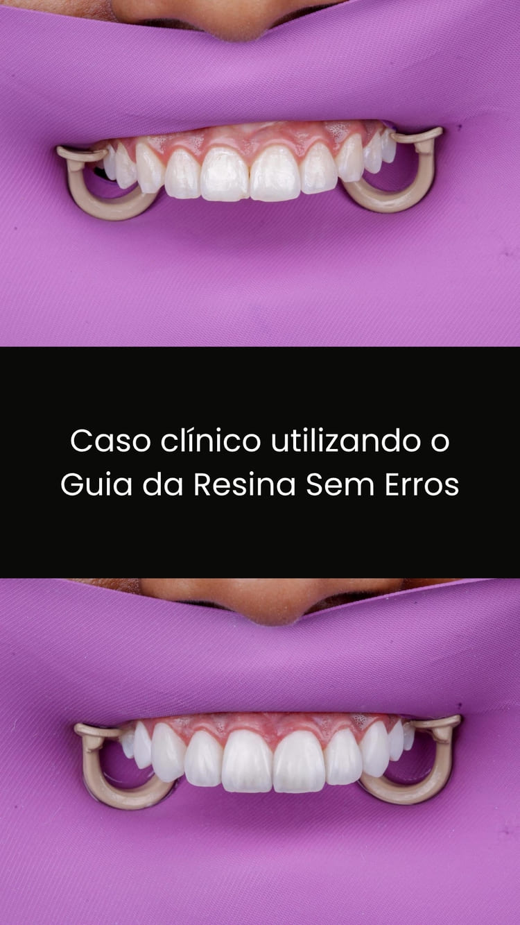 Exemplo visual de dúvida na escolha das resinas